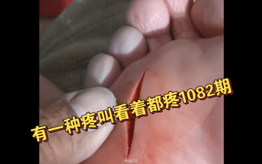 有一种疼叫看着都疼1082期-1.jpg